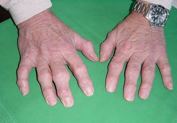 Choroba zwyrodnieniowa stawów palców