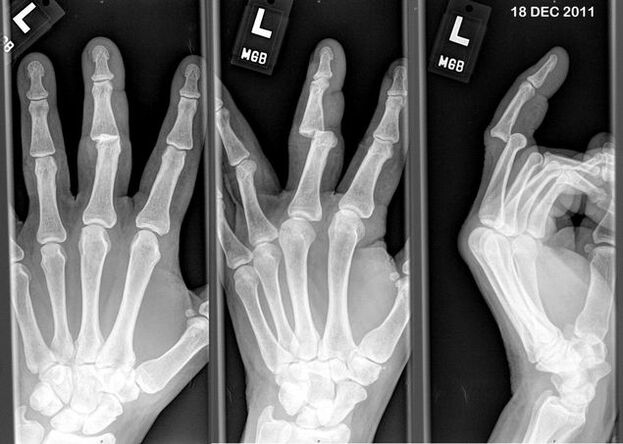 Zdjęcie rentgenowskie zwichniętych palców
