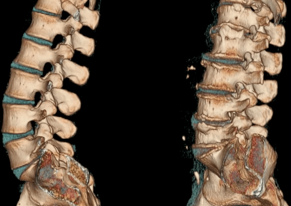 osteochondroza