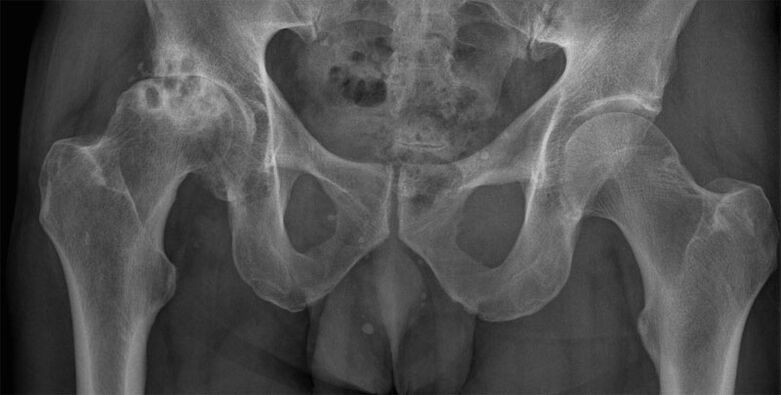 Deformacja artrozy stawu biodrowego na zdjęciu rentgenowskim