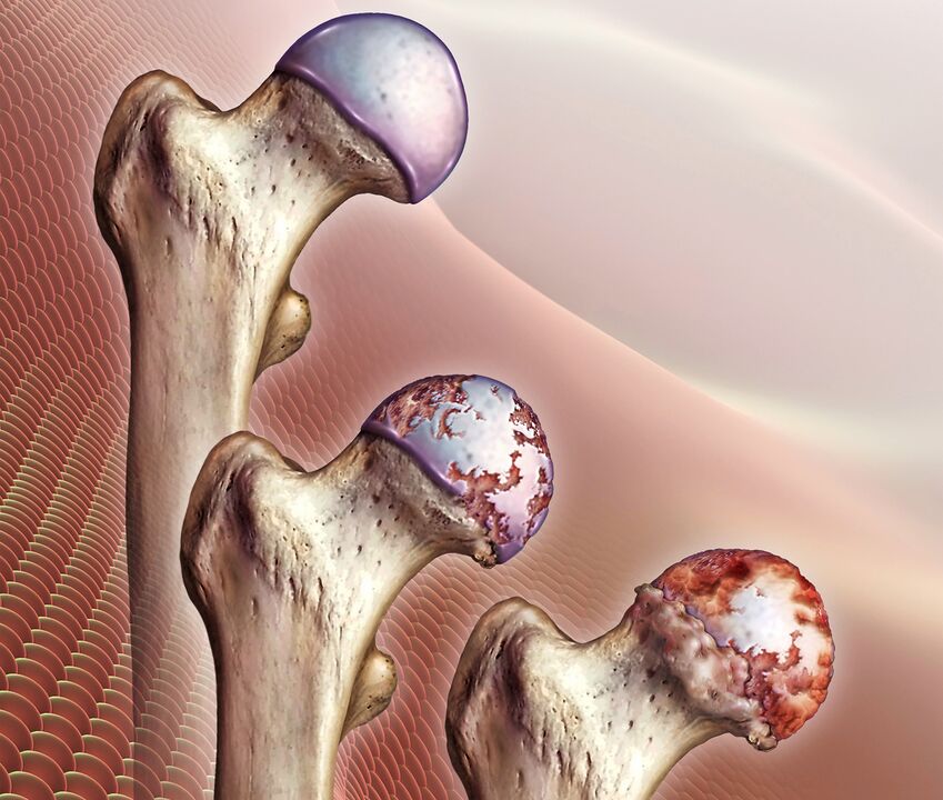 Rozwój artrozy stawu biodrowego