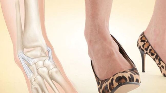 noszenie butów na obcasach jako przyczyna artrozy stawu skokowego