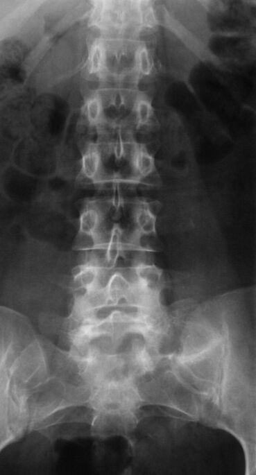 Aby zdiagnozować osteochondrozę lędźwiową, wykonuje się radiografię